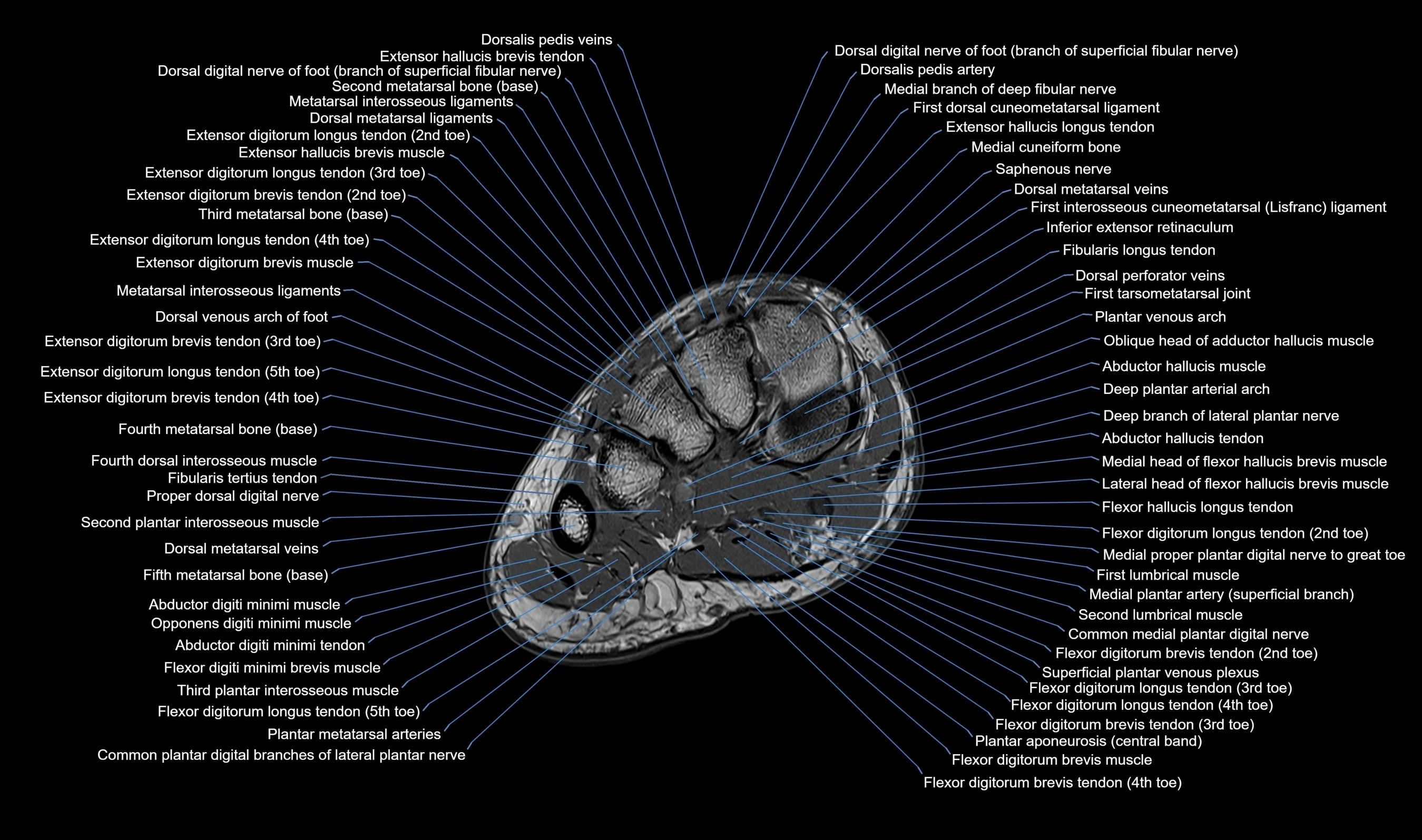 MRI mid foot axial cross sectional anatomy 3T  radiology  image-img-00001-00014.webp